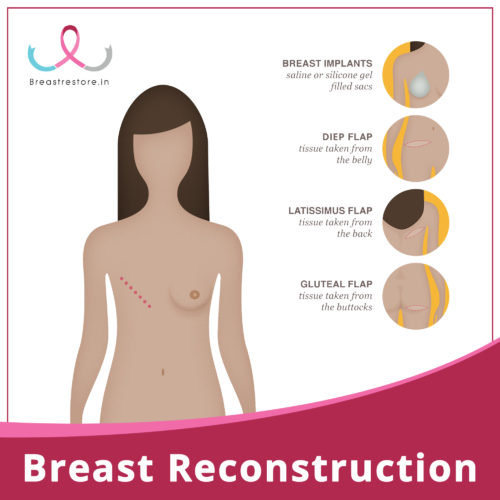 Types of Breast Reconstruction by Breast Restore